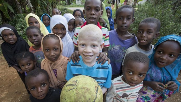 Cules - Página 13 Albinism-in-Malawi-Sightsavers.-1400x788-1-696x392-1